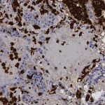 Un estudio abre la puerta a usar un medicamento contra el cáncer para la covid-19