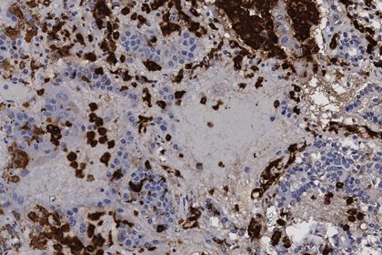 Un estudio abre la puerta a usar un medicamento contra el cáncer para la covid-19