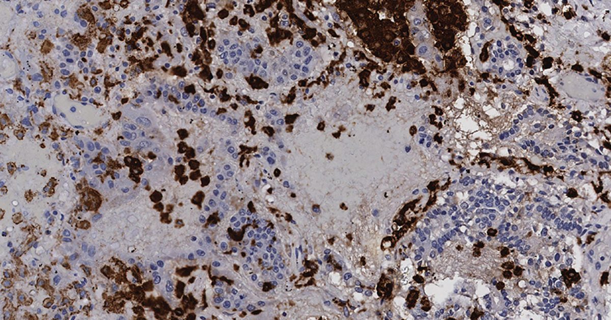 Un estudio abre la puerta a usar un medicamento contra el cáncer para la covid-19